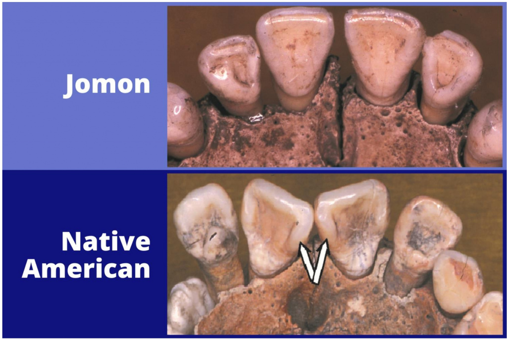 Визуальное различие зубного ряда, типичного, соответственно, для представителей населения дзёмон, и коренного населения Америки (у последних центральные резцы сближены и развёрнуты относительно оси). Источник: Taylor & Francis Group.